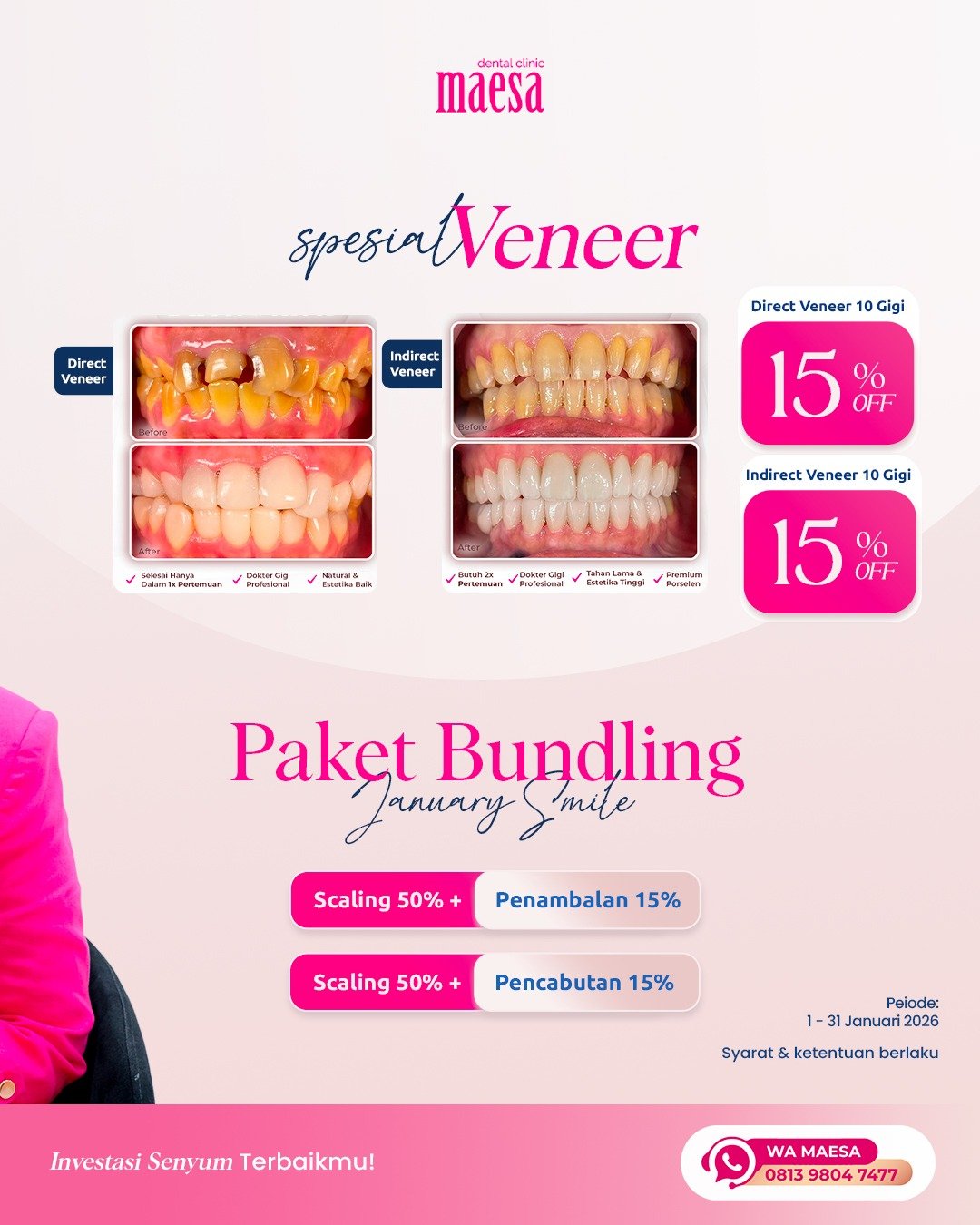 NEWS Maesa Dental Clinic | Klinik Gigi Terbaik - Paket Bundling Januari