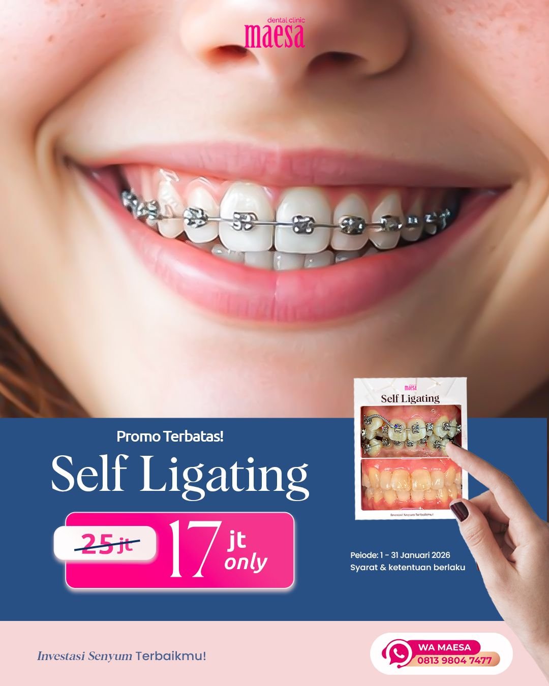 NEWS Maesa Dental Clinic | Klinik Gigi Terbaik - Promo Self Ligating