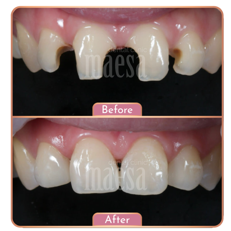 Direct Veneer