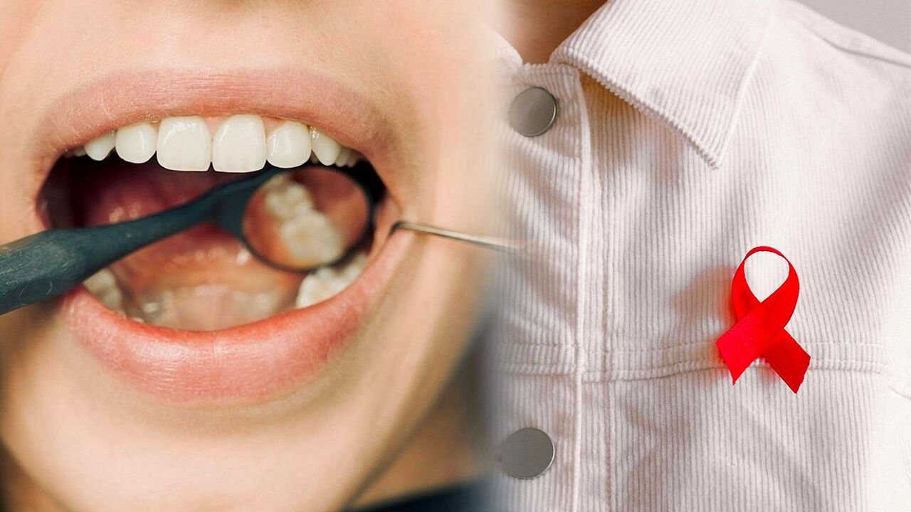 NEWS Maesa Dental Clinic | Klinik Gigi Terbaik - Kenali Gejala infeksi Virus HIV pada Rongga Mulut!