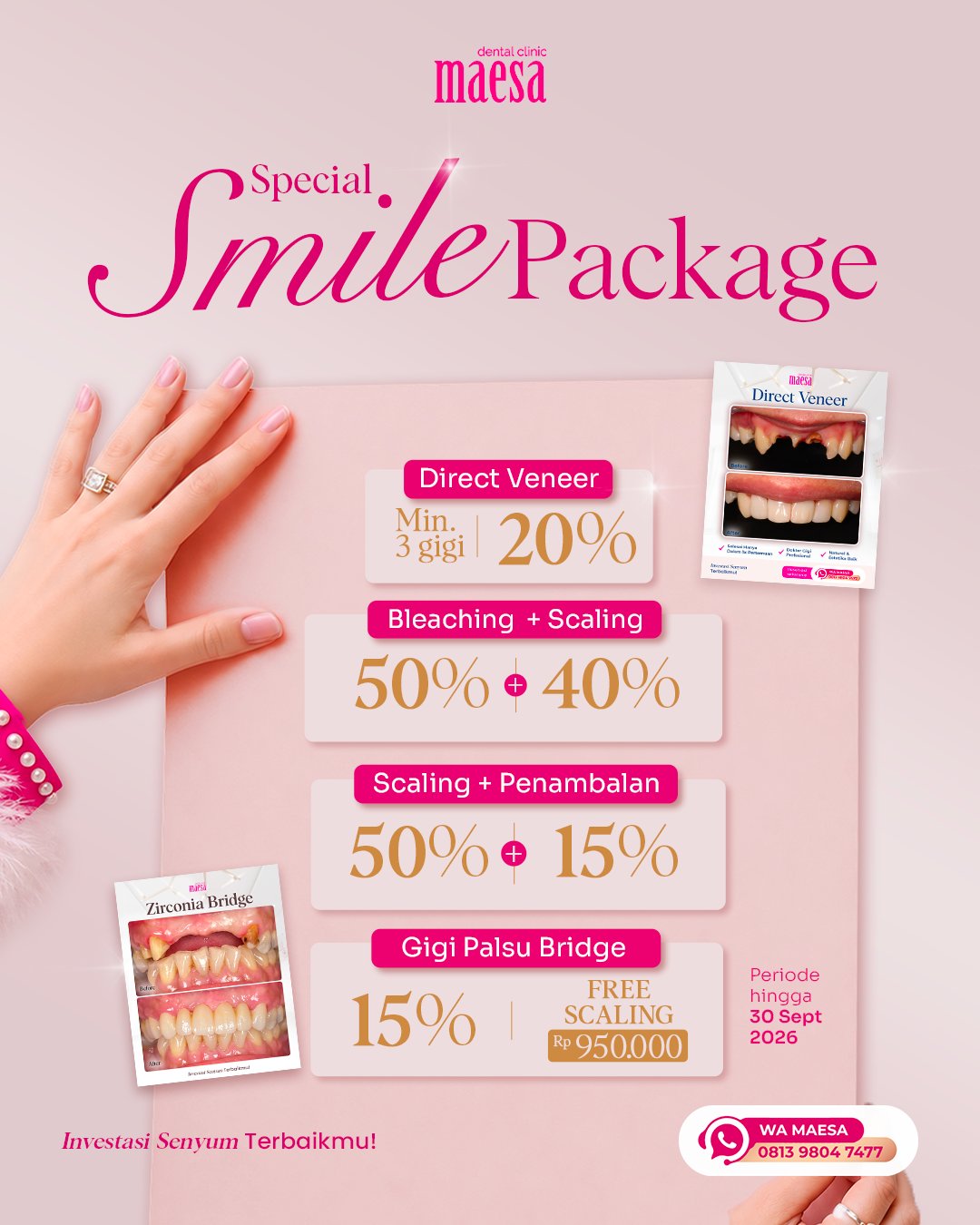 PROMO Maesa Dental Clinic | Klinik Gigi Terbaik - Special Smile Package