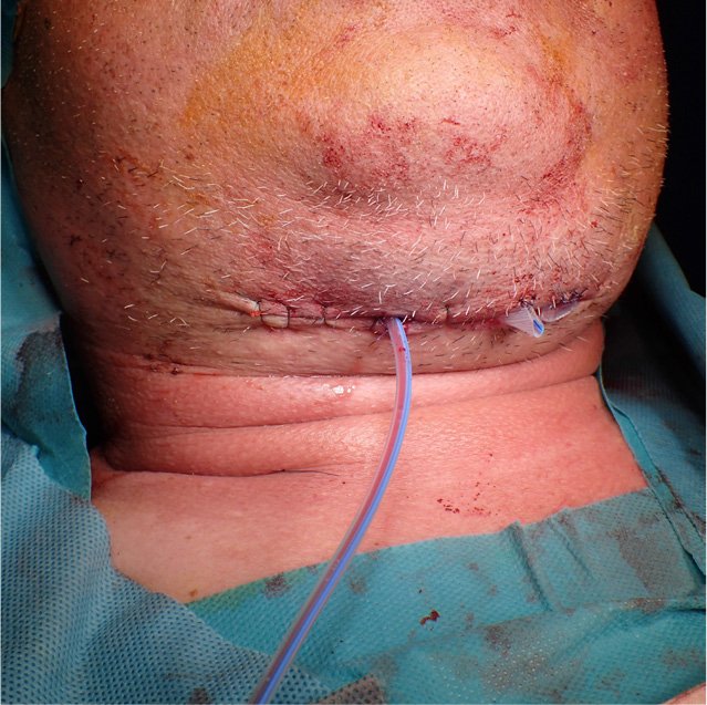 NEWS Maesa Dental Clinic | Klinik Gigi Terbaik - Abses Pada Leher Akibat Menunda Perawatan Gigi