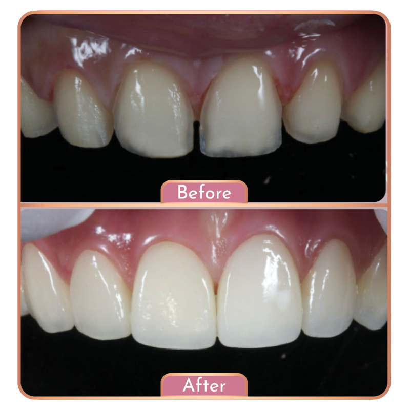 Inderect Veneer