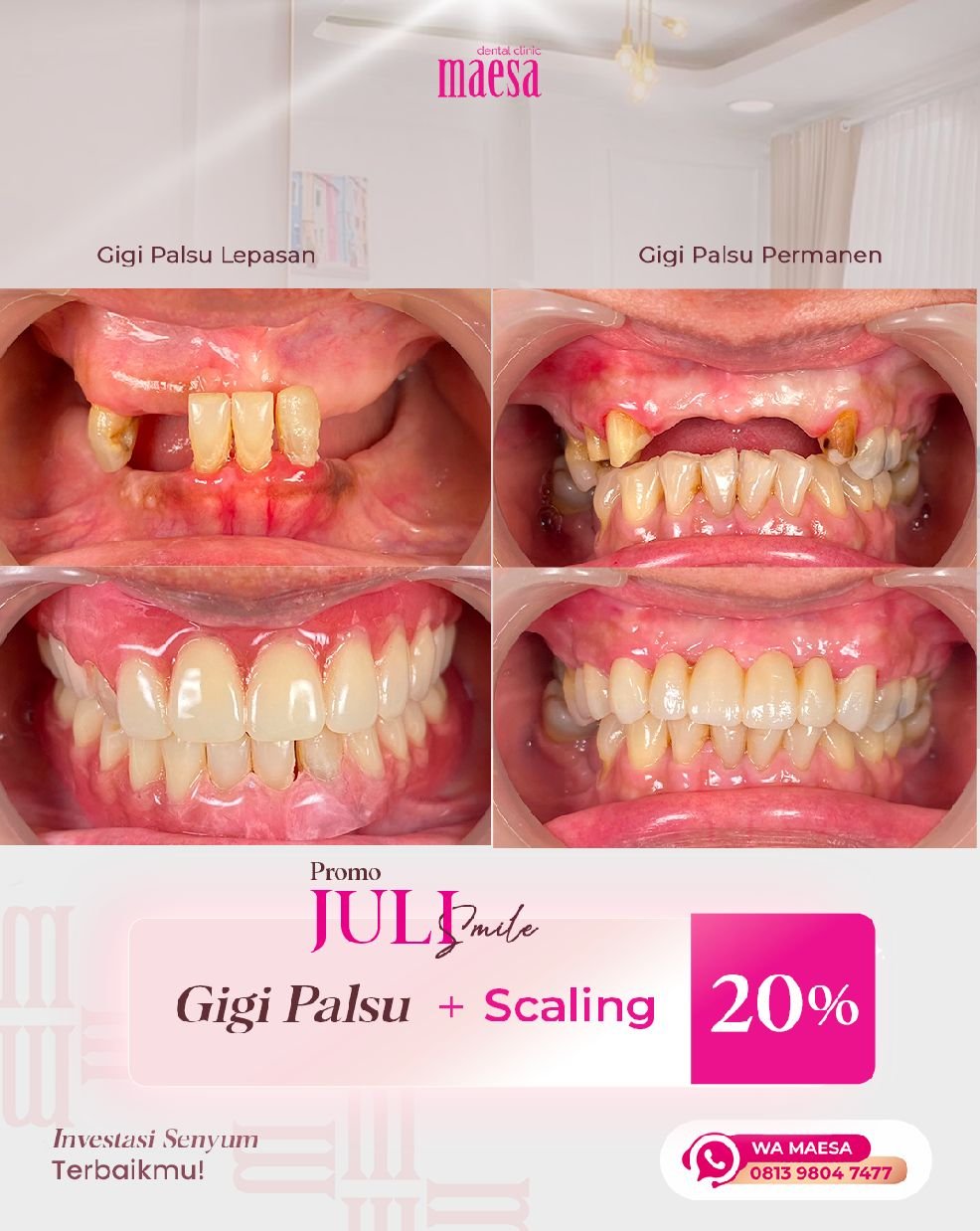 PROMO Maesa Dental Clinic | Klinik Gigi Terbaik - Promo Gigi Palsu Juli